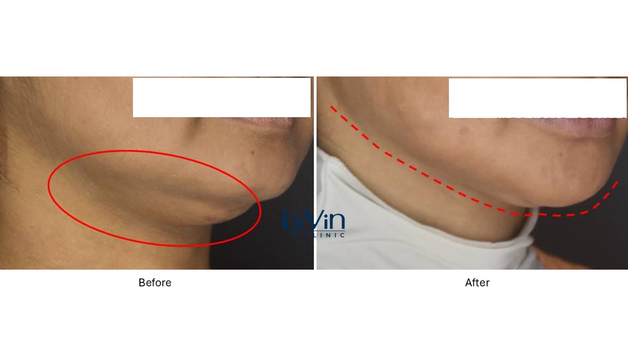 CoolSculpting before and after photo showing double chin fat reduction